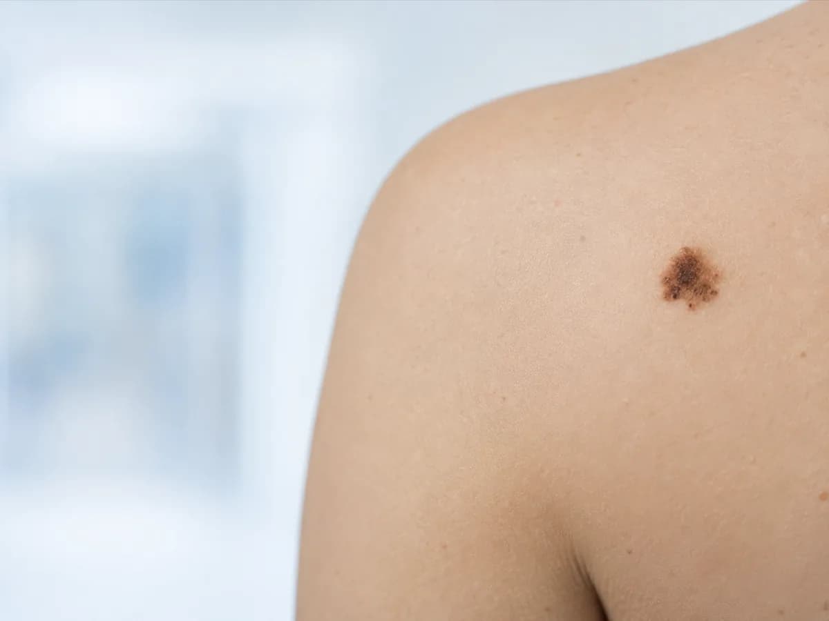 Chirurgie du mélanome — photographie d'illustration